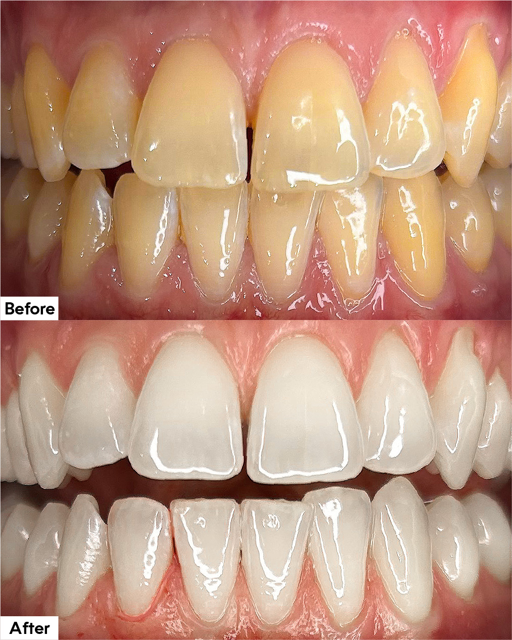 Airflow or Air-Flow Plus before and after hygienist appointment