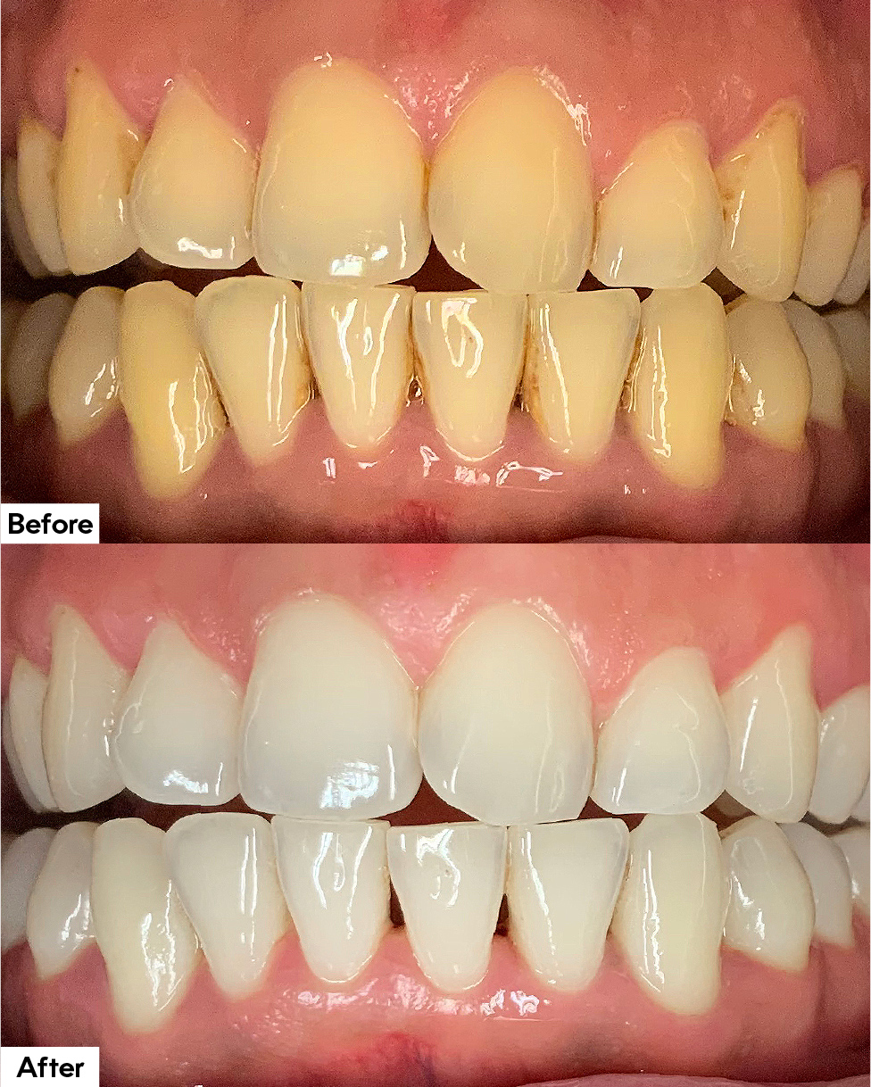 Airflow or Air-Flow Plus before and after hygienist appointment