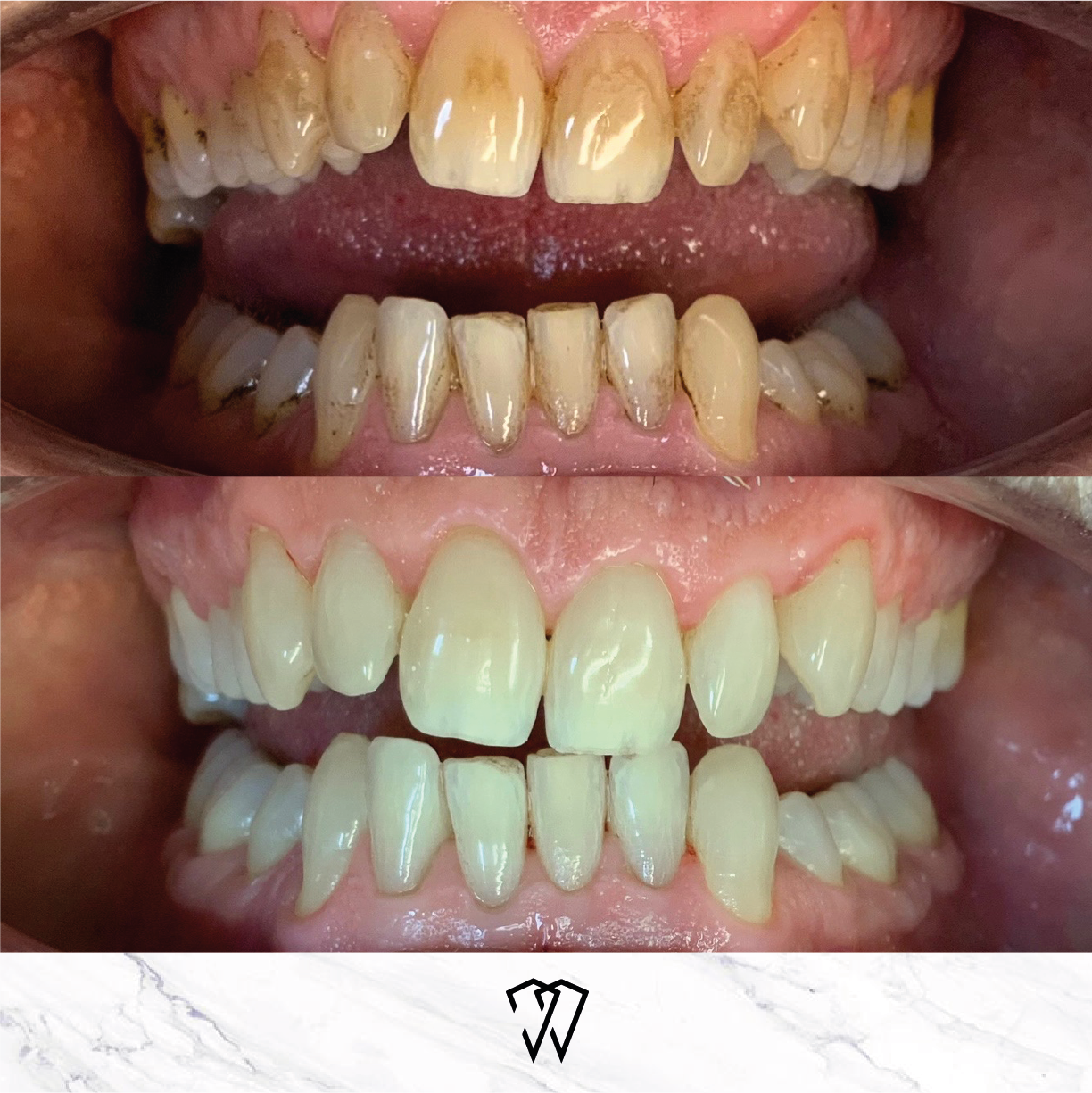 Before and after visit to dental hygienist in Leigh on Sea
