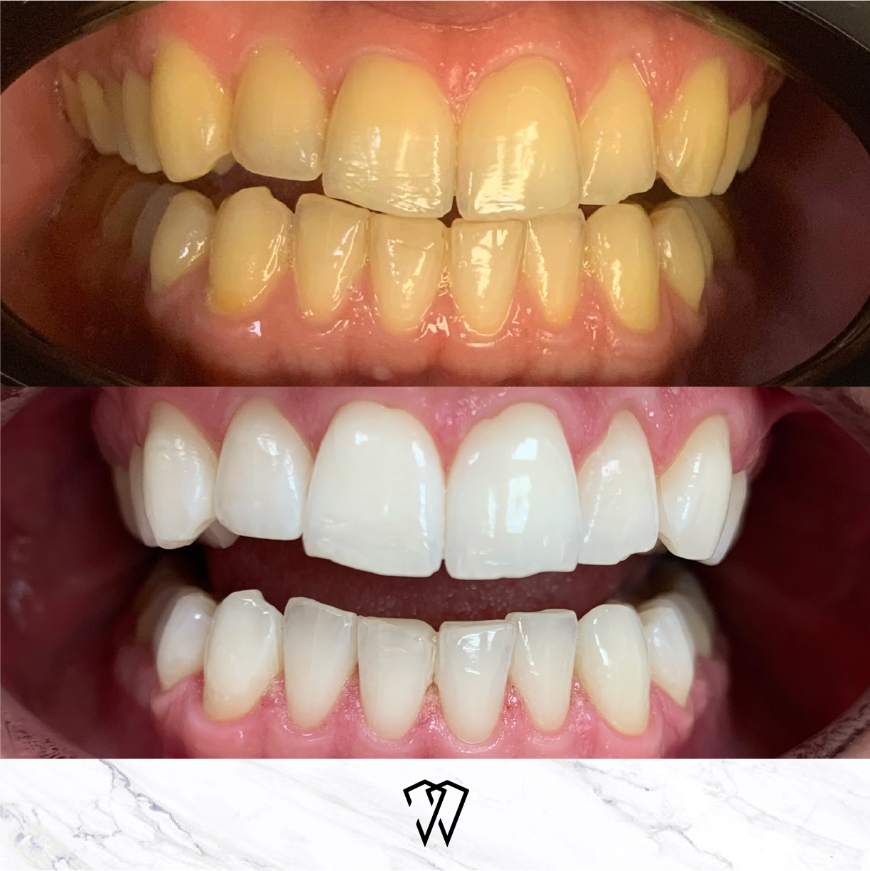 discoloured teeth before and after Boutique Whitening in Leigh on Sea