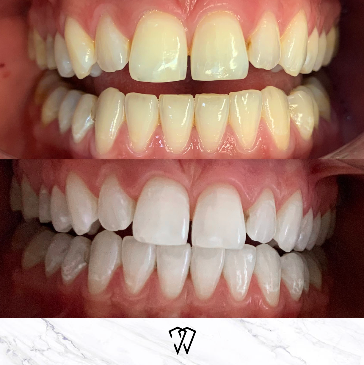 discoloured teeth before and after Boutique Whitening in Leigh on Sea