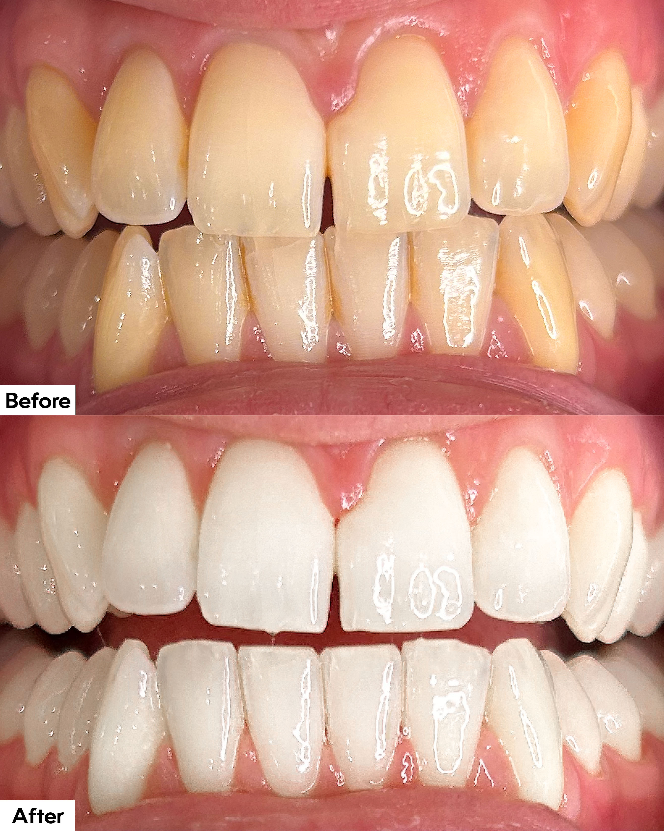 Boutique whitening before and after images