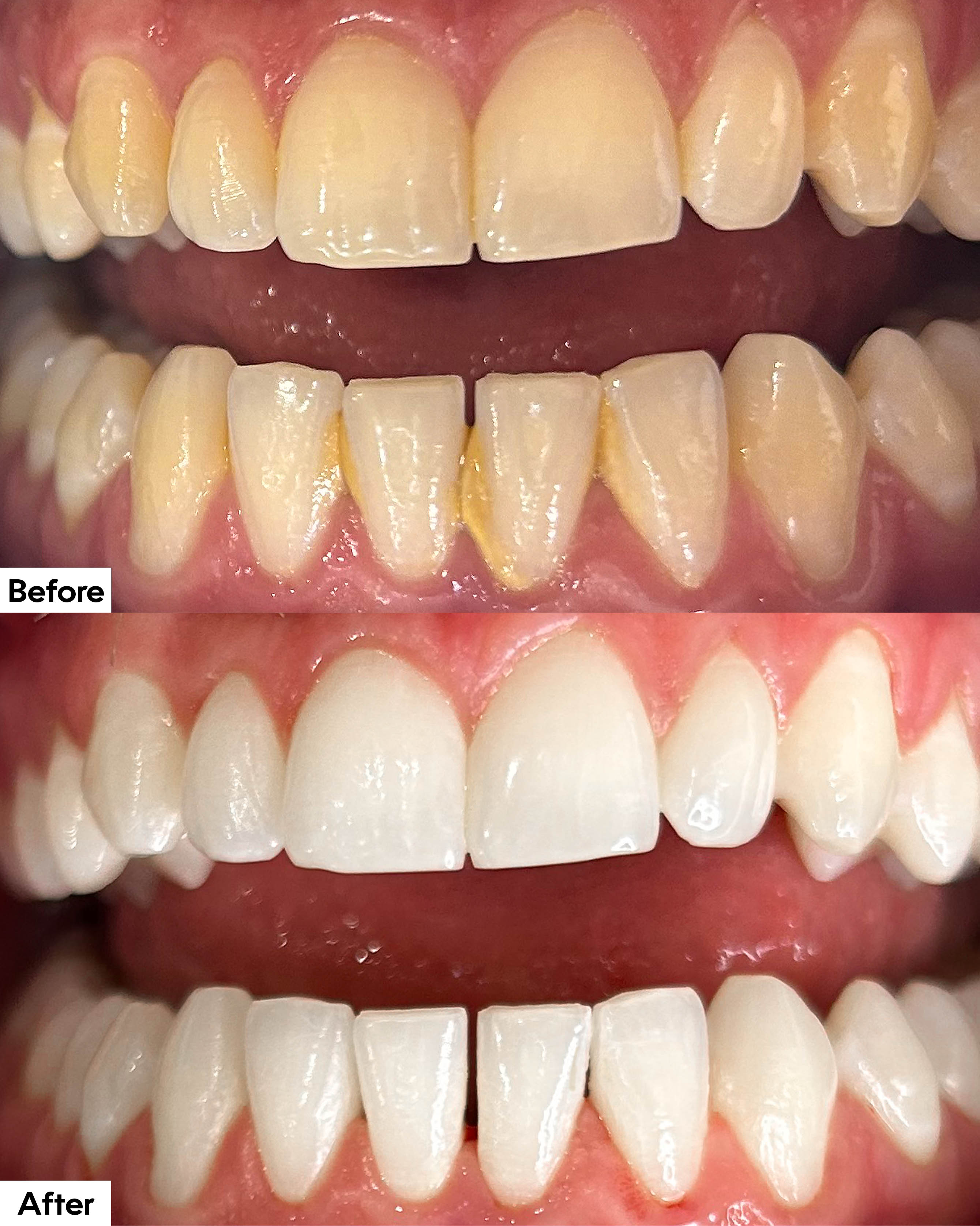 Boutique whitening before and after images