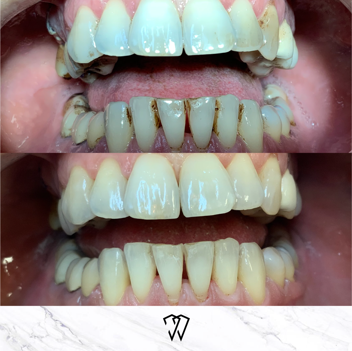 Teeth cleaning and polishing before and after images