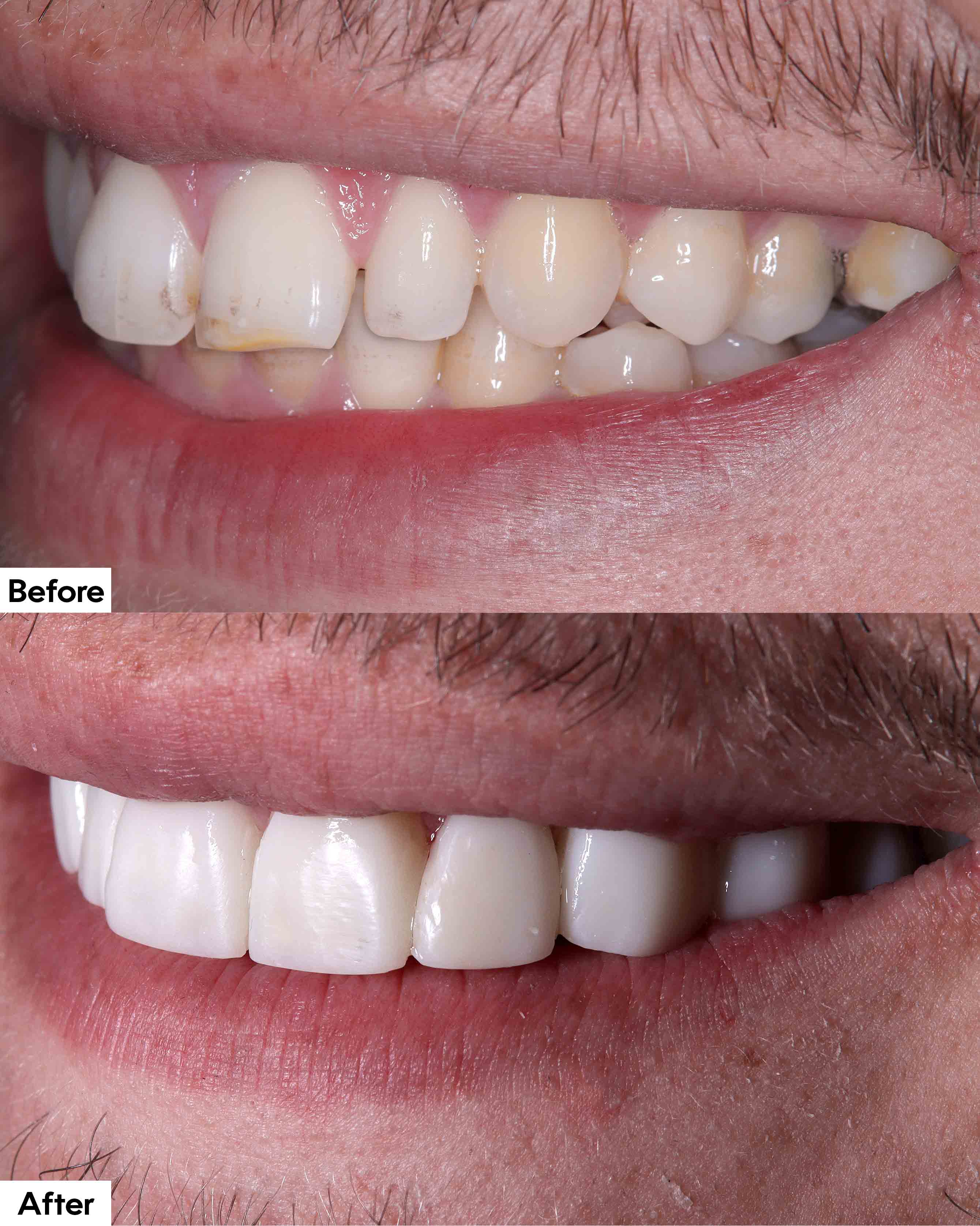 Before and after teeth repair with composite dental bonding