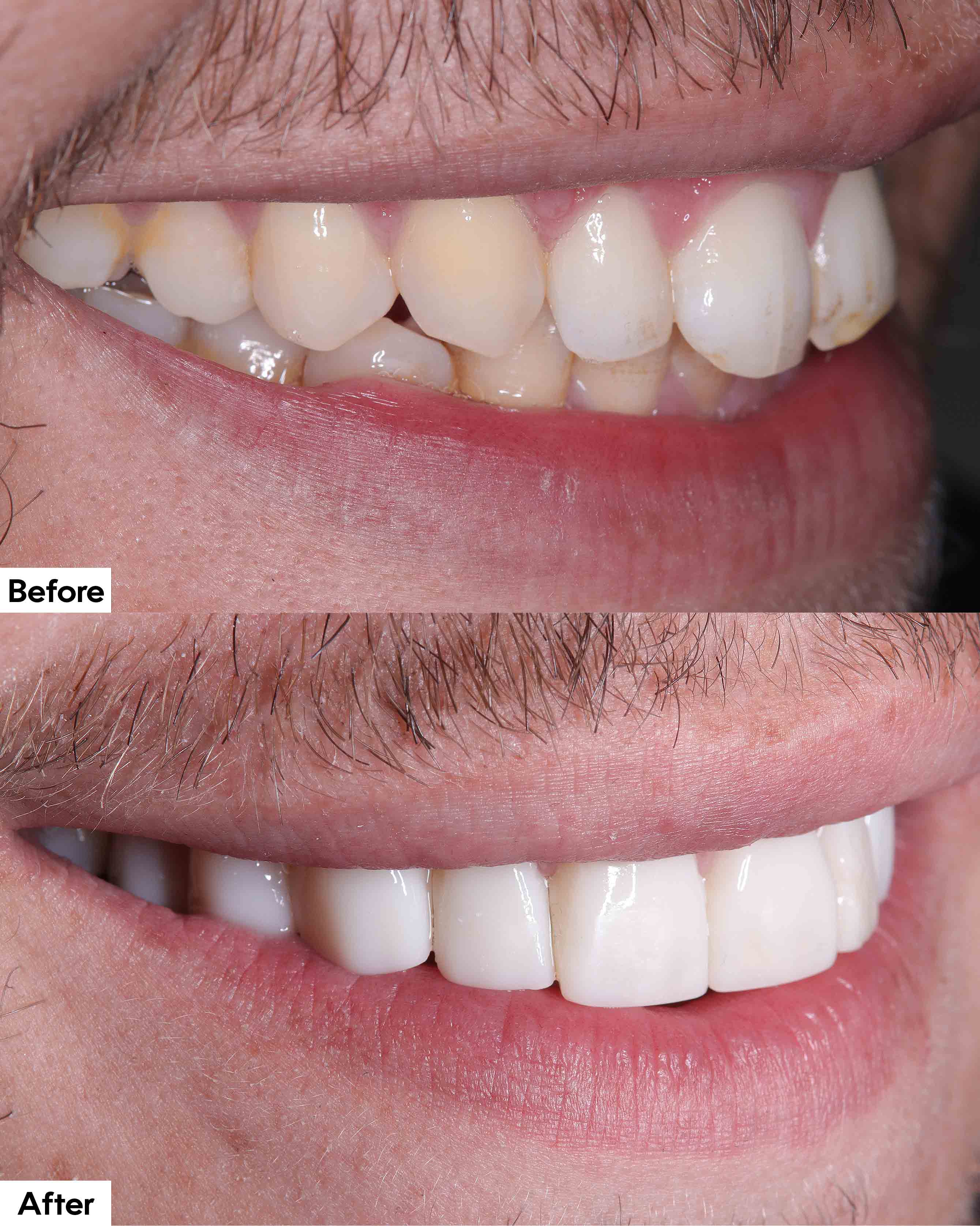 Before and after teeth repair with composite dental bonding