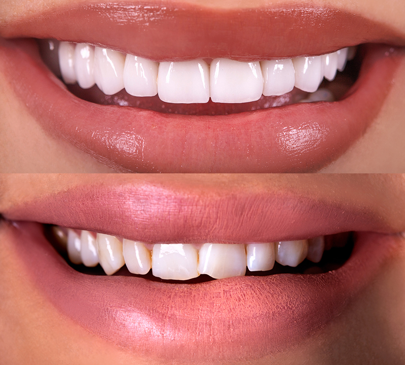 Before and after composite dental bonding for customer in Leigh on Sea