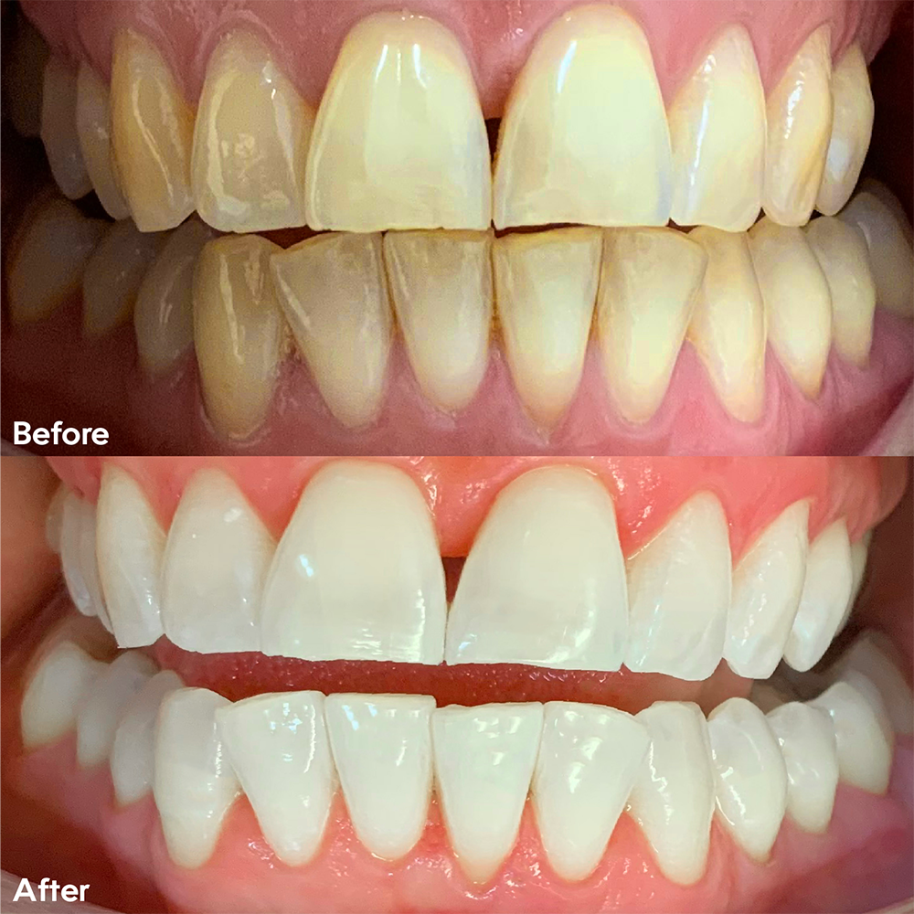 Before and after showing difference of discoloured teeth and teeth after whitening